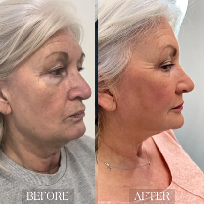 skin_rejuvenation_ba_1