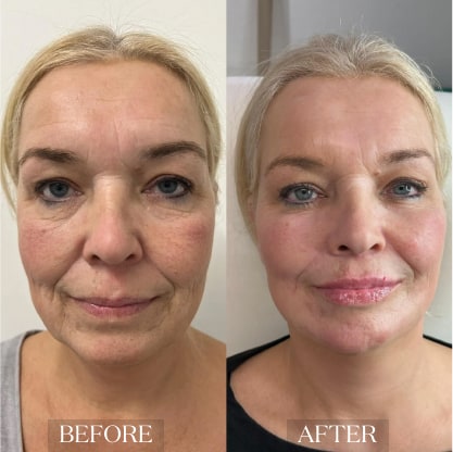 skin_rejuvenation_ba_2