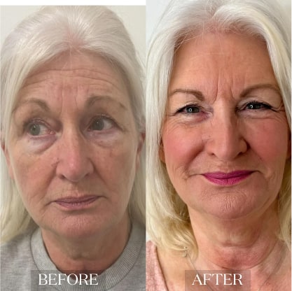 skin_rejuvenation_ba_3