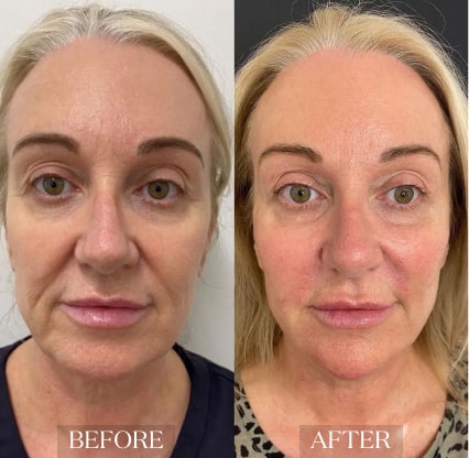 skin_rejuvenation_ba_5