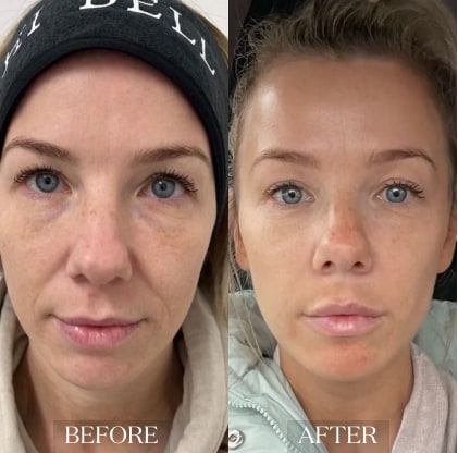 skin_rejuvenation_ba_6